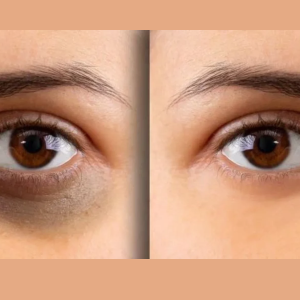 DARK CIRCLES
