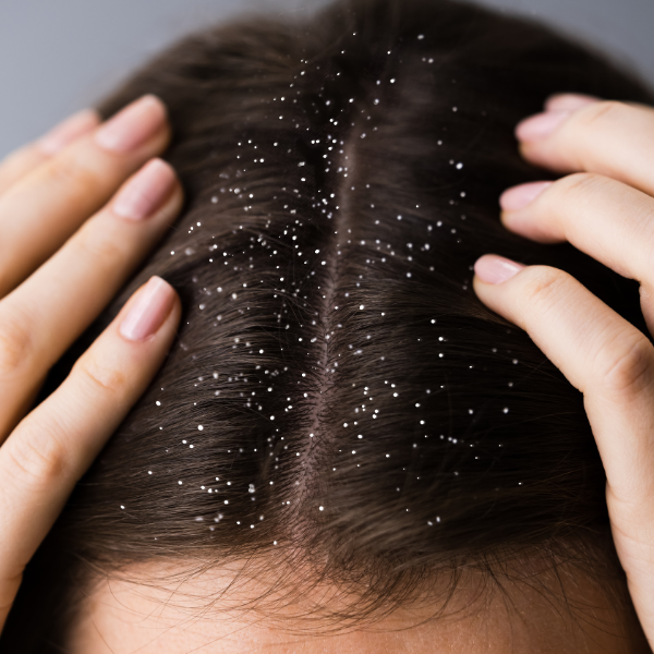 DANDRUFF