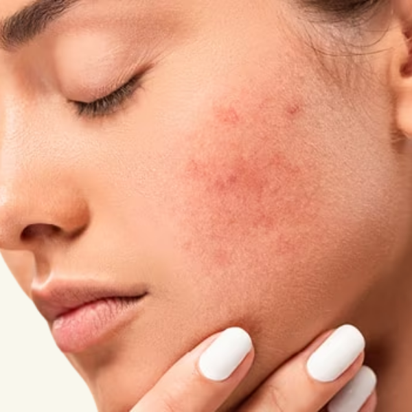 FREE FROM ANTI - INFLAMATION