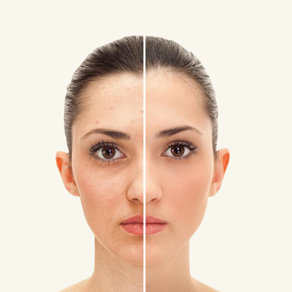 PIGMENTATION