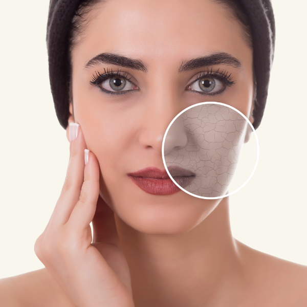 DRY SKIN